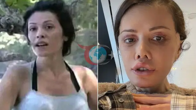 Didem Ceran'ın Yüz Nakli Deneyimi: Kaşında Saç Çıktı