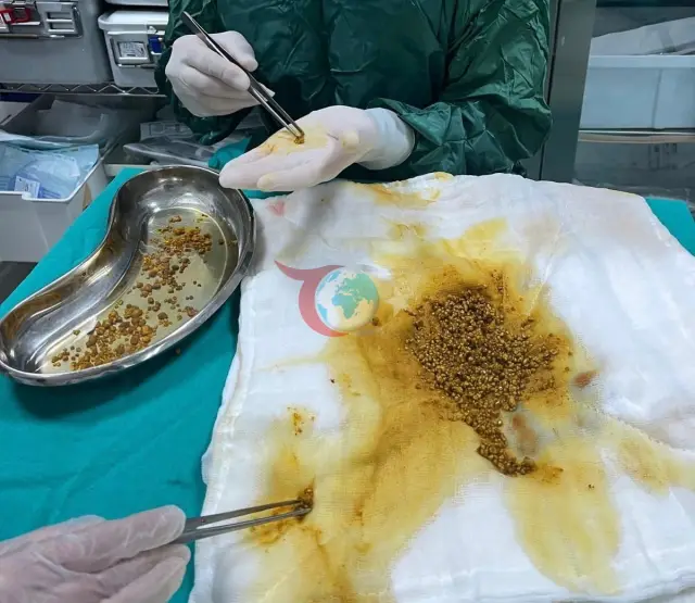 Bingöl'de Eşine Az Rastlanır Operasyon: Safra Kesesinden 2 Bin 67 Taş Çıkarıldı