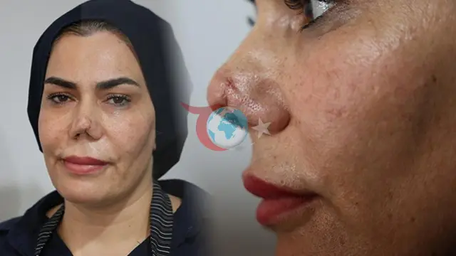 Элазыгтағы медициналық қате туралы мәлімдеме: оның сынған мұрны 4 операциядан кейін танылмай қалды