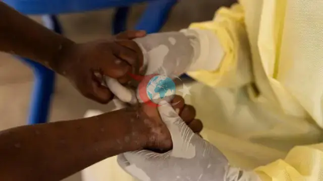 Güney Afrika'da M Çiçeği Alarmı: Son 5 Haftada Vaka Sayısında Hızlı Artış