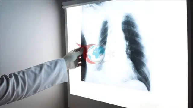 Tütündən istifadə ağciyər xərçəngi riskini 30 dəfəyə qədər artırır