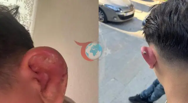 Bursa'da piercing sonrası enfeksiyon geçiren gençle ilgili işletmeye denetim
