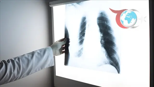 Viral Enfeksiyonların Solunum Üzerindeki Etkileri ve Korunma Yöntemleri