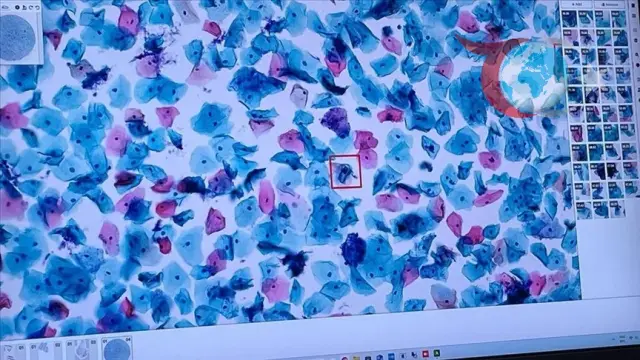 Yapay Zeka Sağlıkta Devrim Yaratıyor: Kanser Tanı ve Tedavisinde Yeni Dönem