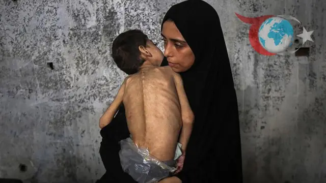 Gazze'de Yetersiz Beslenme Krizi: Çocuklar ve Yetişkinler Hayatını Kaybediyor