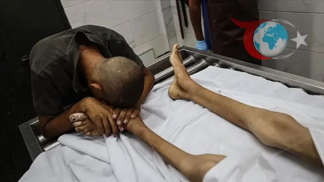 Gazze'de İnsani Kriz: Yetersiz Beslenme Bir Çocuğun Daha Canını Aldı