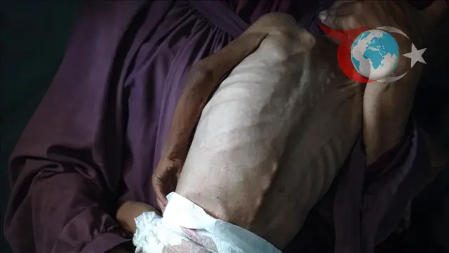 Gazze'de Kıtlık Krizi: Açlık ve Yetersiz Beslenme Felaketi