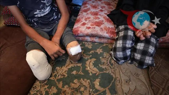 Gazze'de Sağlık Krizi: Amputasyonların Korkunç Boyutları