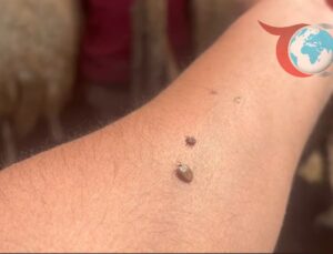 Kırım Kongo Kanamalı Ateşi Vakalarına Karşı Alınacak Önlemler