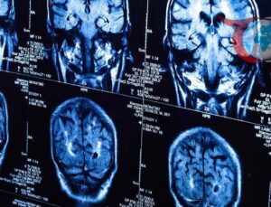 Beyin Yaşlanması Pandemiyle Hızlandı: Yapay Zeka Destekli Araştırmadan Çarpıcı Bulgular