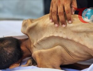 Gazze’de İnsani Kriz: Açlıktan Hayatını Kaybedenler Artıyor