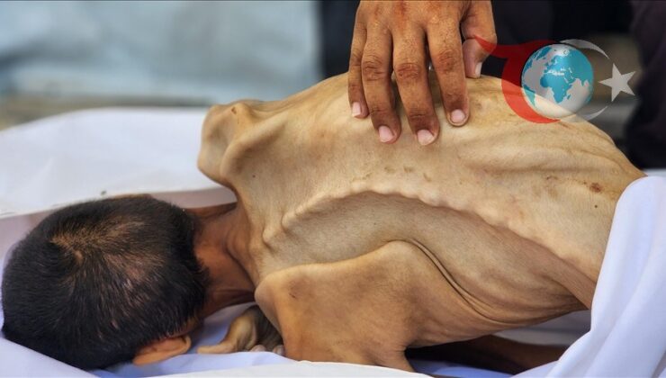 Gazze’de İnsani Kriz: Açlıktan Hayatını Kaybedenler Artıyor