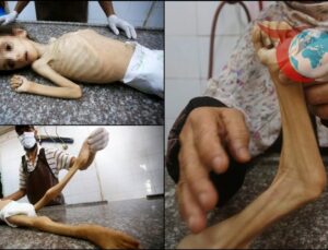 Gazze’de Yetersiz Beslenme Krizi: Çocuklar Tehlikede