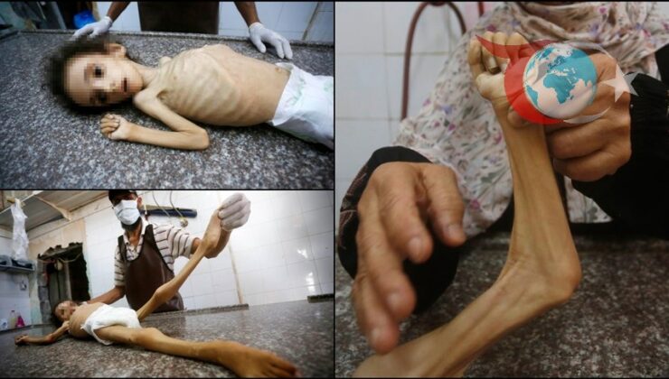 Gazze’de Yetersiz Beslenme Krizi: Çocuklar Tehlikede