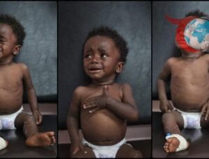 Gazze’deki Yetersiz Beslenme Krizi Binlerce Çocuğu Tehdit Ediyor