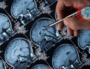 Alzheimer ile Mücadelede Lityum Çağı: Yeni Araştırmalar Umut Vaad Ediyor