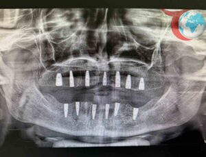 Bayburt’ta Diş İmplantıyla Yepyeni Bir Gülüş