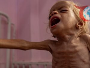 Gazze’de Kriz Derinleşiyor: Yetersiz Beslenme ve Açlıktan Ölümler Artıyor