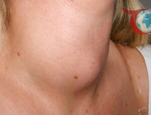 Guatr Hastalığı: Belirtiler, Tanı ve Tedavi Yöntemleri