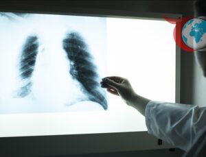 Akciğer Kanserinde Erken Teşhis Yaşam Kurtarıyor