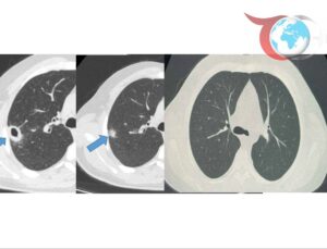 Bayburt Devlet Hastanesinde Erken Tanı ile Hastalık Tedavi Edildi